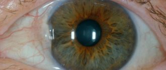 Вмятина на зрачке