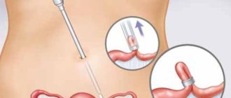 Месячные после лапароскопии маточной трубы