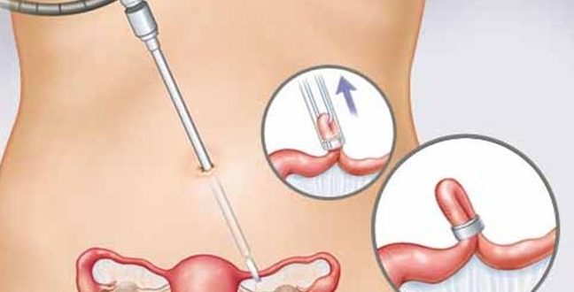 Месячные после лапароскопии маточной трубы