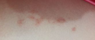 Долго не проходит пятно