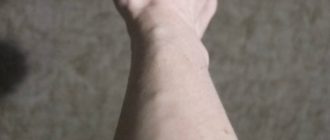 На вене бугорок