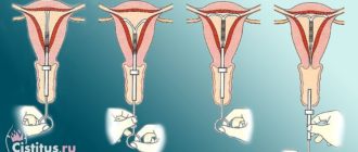 Месячные после установки спирали