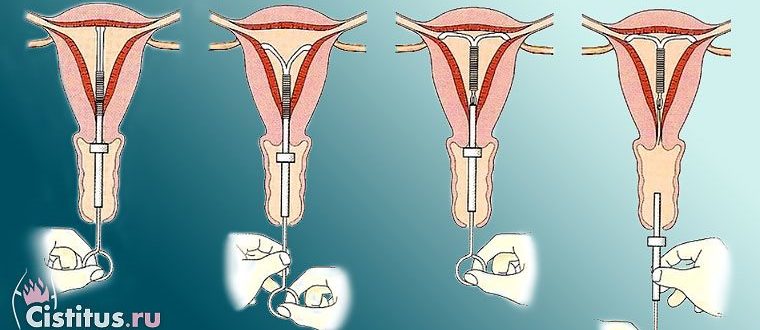 Месячные после установки спирали